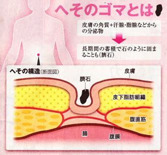 臍石除去|気になるへそのゴマ、取ってもいいの？（朝日新聞掲。